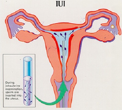 IUI Treatment Cost for Pregnancy Process and Success Rate at Mishka IVF jaipur