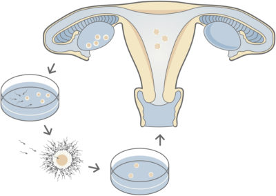 IVF clinic in Australia