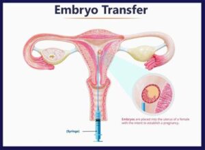 Embryo transfer process